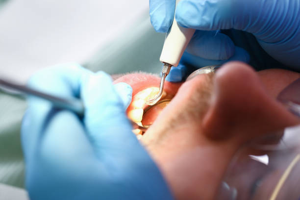 Best Emergency Wisdom Teeth Removal in Champaign, IL
