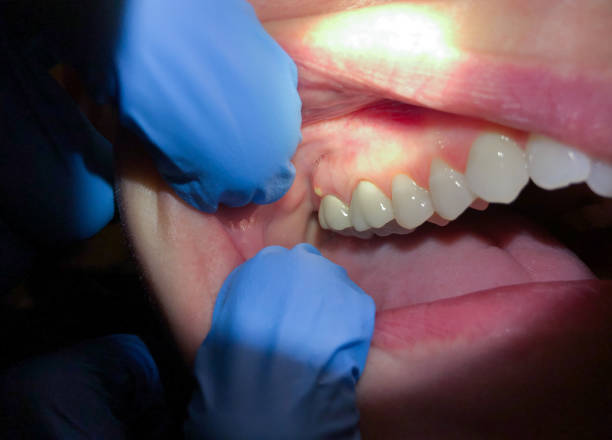 Best Emergency Tooth Extraction in Champaign, IL